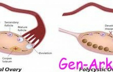 Polikistik Over Sendromu Belirtisi Tedavisi Zararları